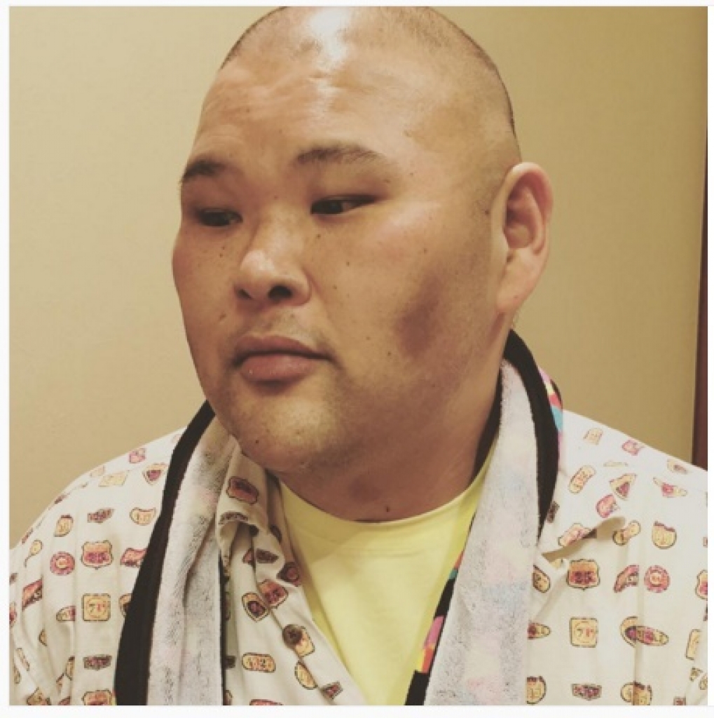 安田大サーカスhiroが痩せて体重激減 病気で入院 ほっぺたが黒い理由は ニュースポ２４